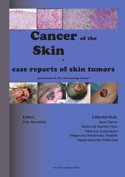 ebook Cancer of the Skin - case reports of skin tumors