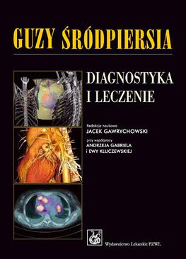 ebook Guzy śródpiersia. Diagnostyka i leczenie